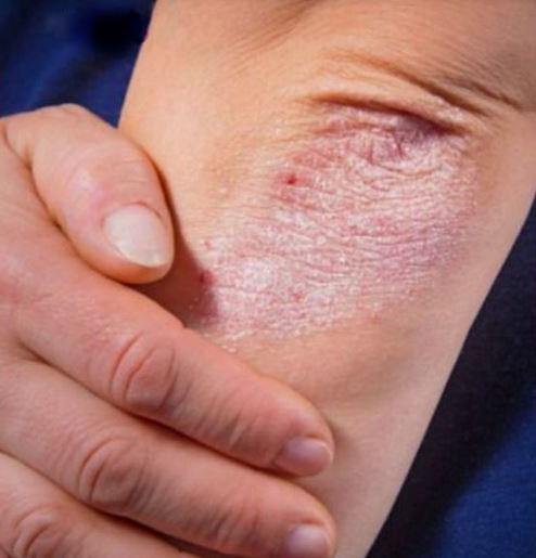 QUÉ ES LA PSORIASIS